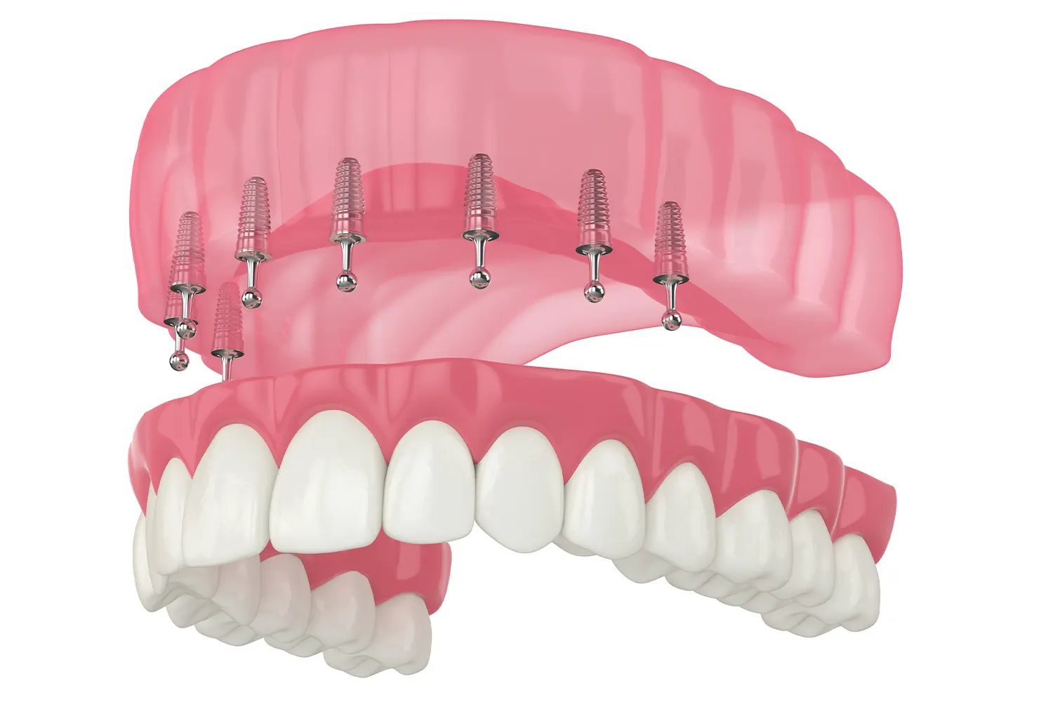 Snap-In Dentures in Lexington, NC | Carolina Pines Dentistry